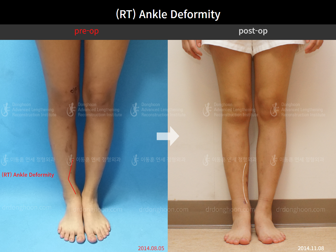 Before and after foot & ankle deformity, case 4248008, image 1, Dr. Donghoon institute (DALRI)