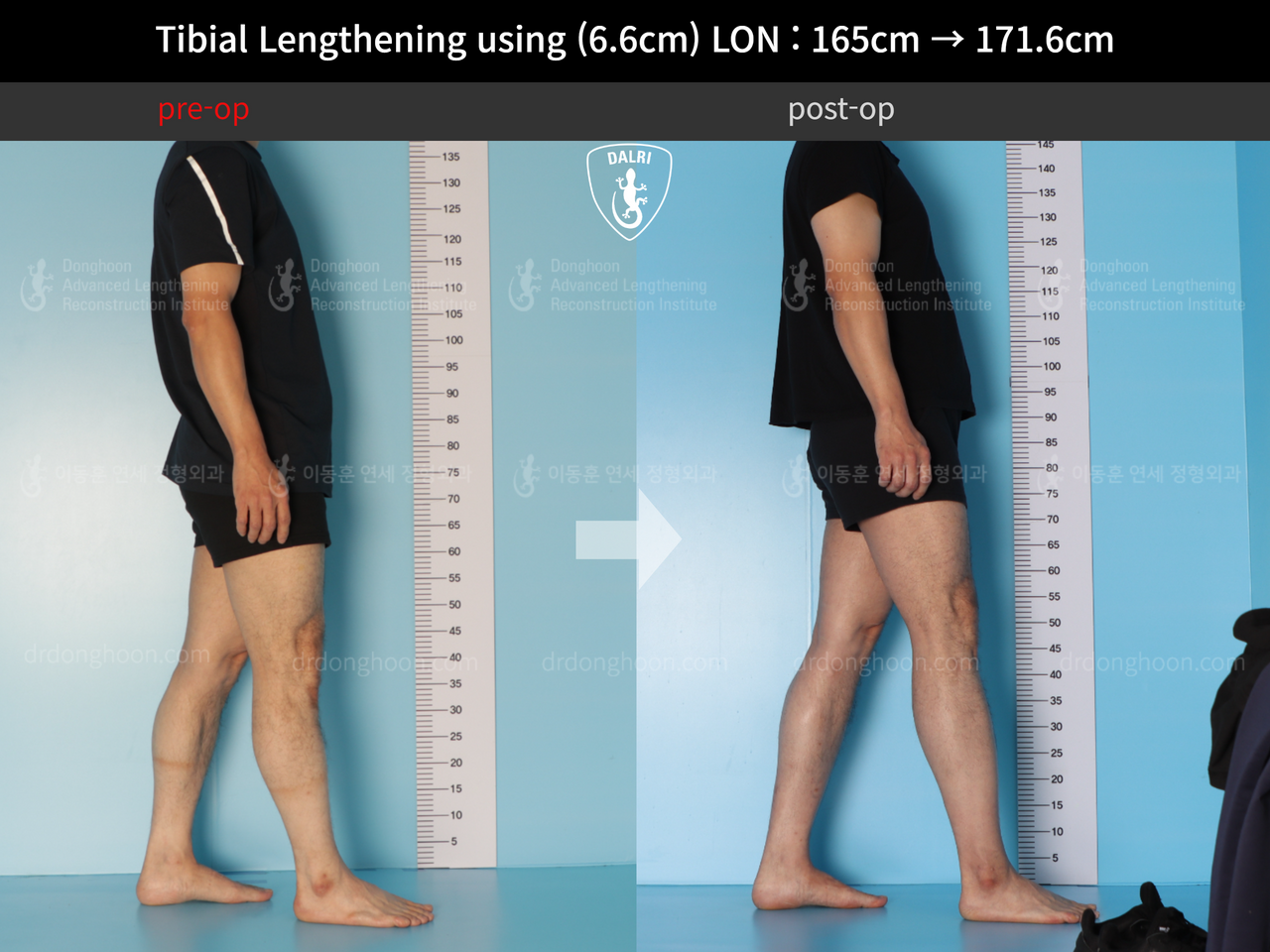 Before and after cll lon, case 12679338, image 3, Dr. Donghoon institute (DALRI)