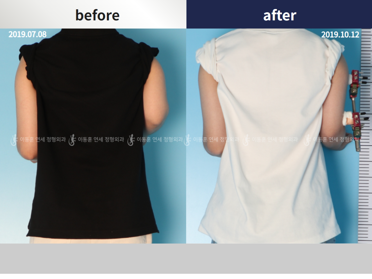 Before and after arm lengthening, case 4249447, image 1, Dr. Donghoon institute (DALRI)