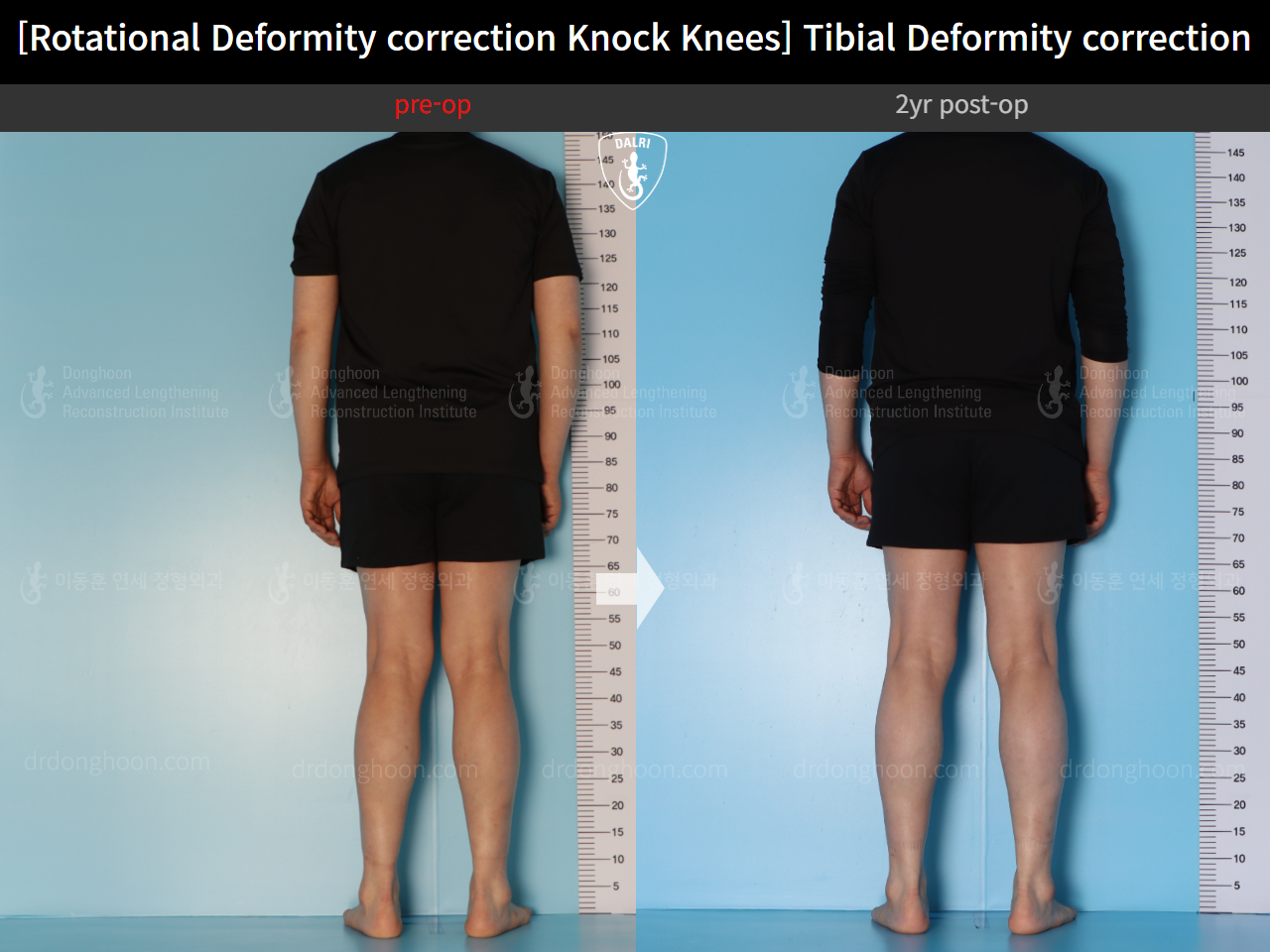 Before and after adult knock knees, case 15524370, image 4, Dr. Donghoon institute (DALRI)