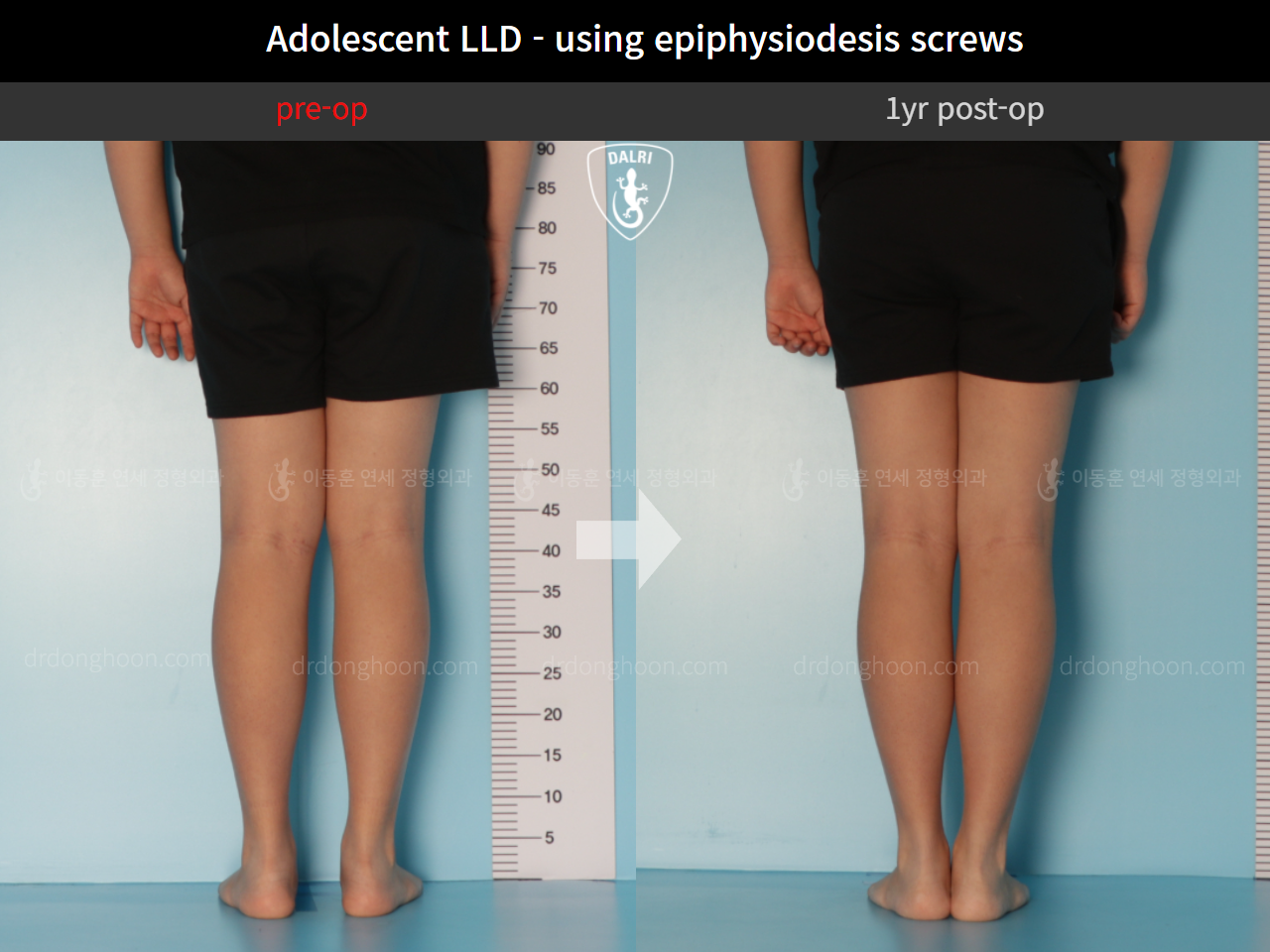 Before and after paediatric & adolescent lld, case 10291768, image 4, Dr. Donghoon institute (DALRI)