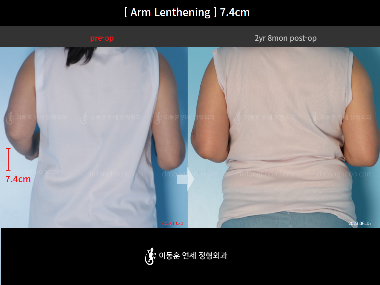 Before and after arm lengthening, case 15460631, image 3, Dr. Donghoon institute (DALRI)