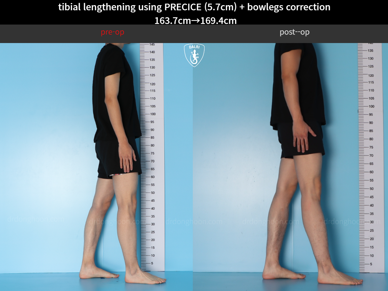 Before and after cll precice, case 38471448, image 4, Dr. Donghoon institute (DALRI)