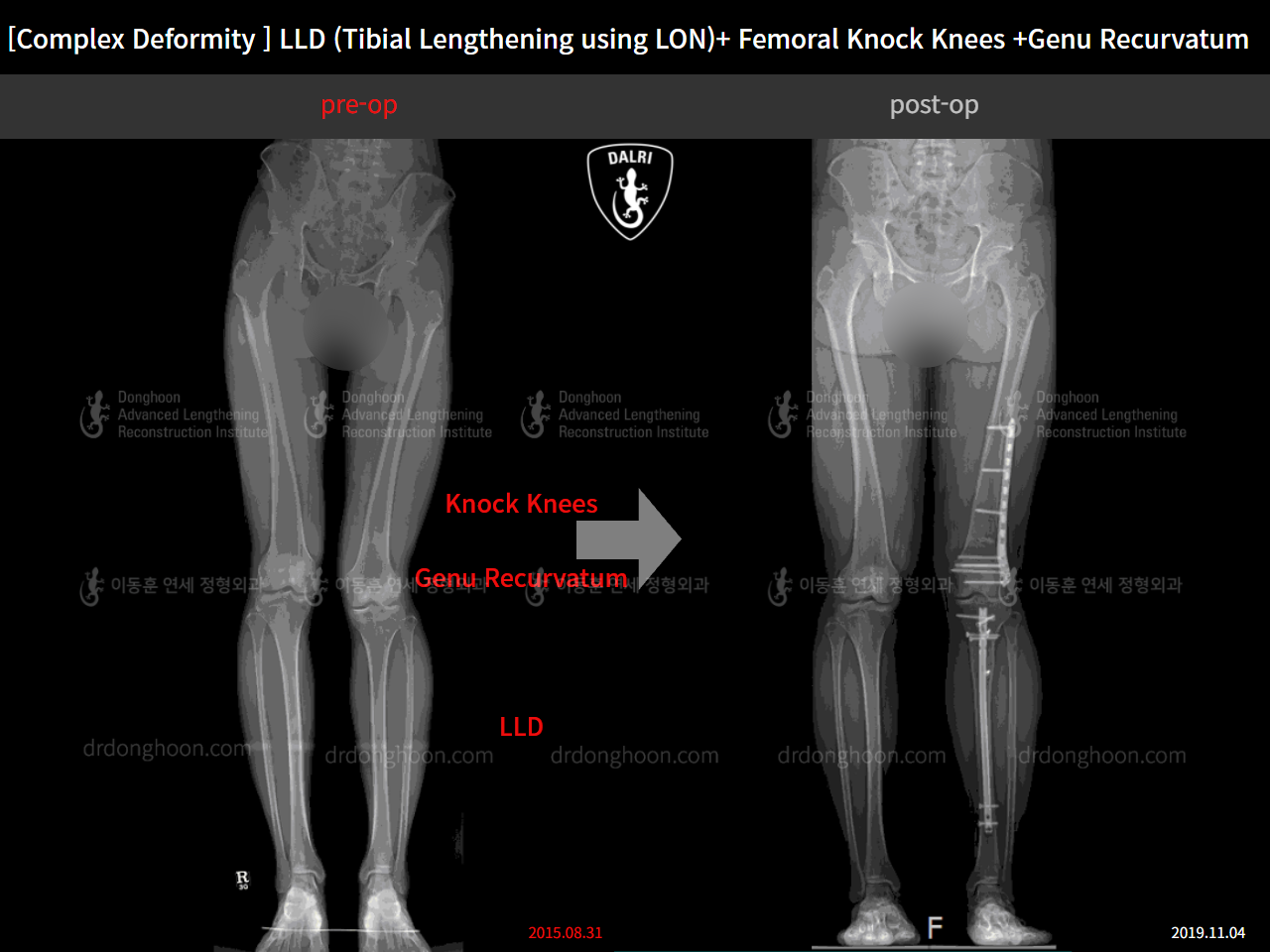 Before and after complex deformity, case 9263548, image 8, Dr. Donghoon institute (DALRI)