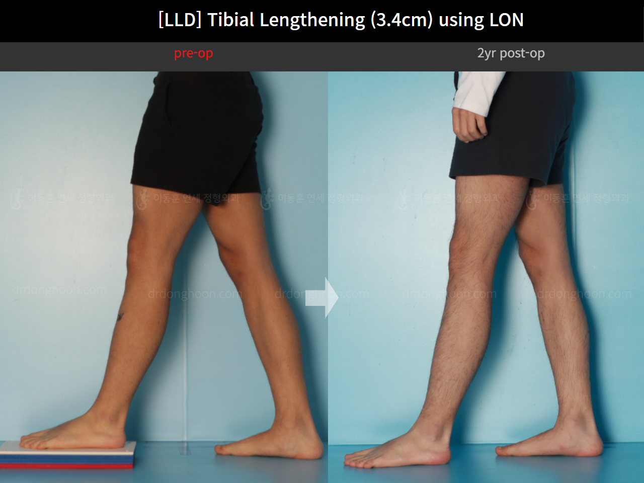 Before and after adult lld, case 17538143, image 7, Dr. Donghoon institute (DALRI)