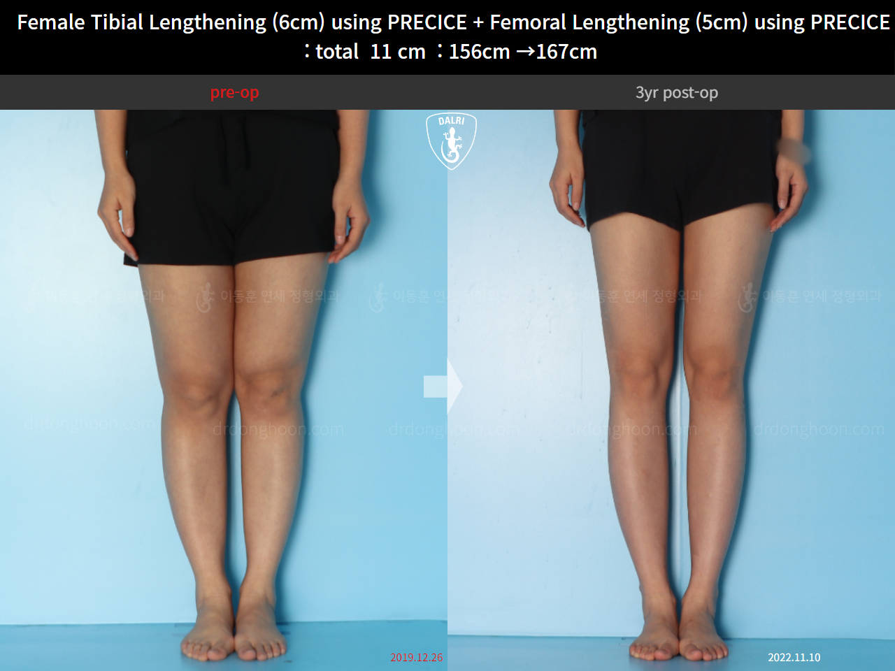 Before and after cll precice, case 24986271, image 5, Dr. Donghoon institute (DALRI)