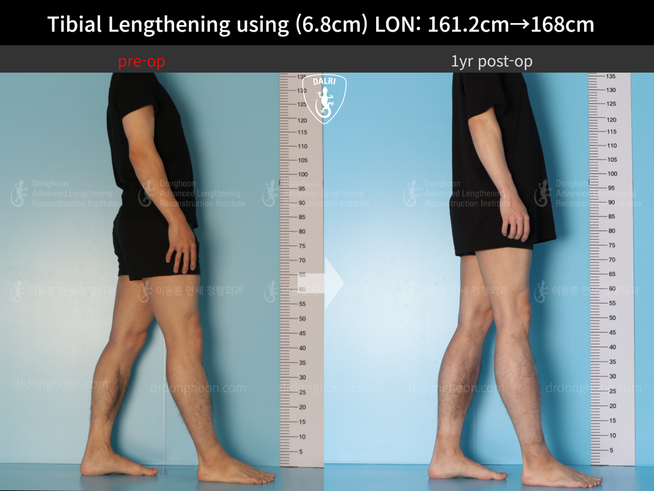 Before and after cll lon, case 13633878, image 5, Dr. Donghoon institute (DALRI)