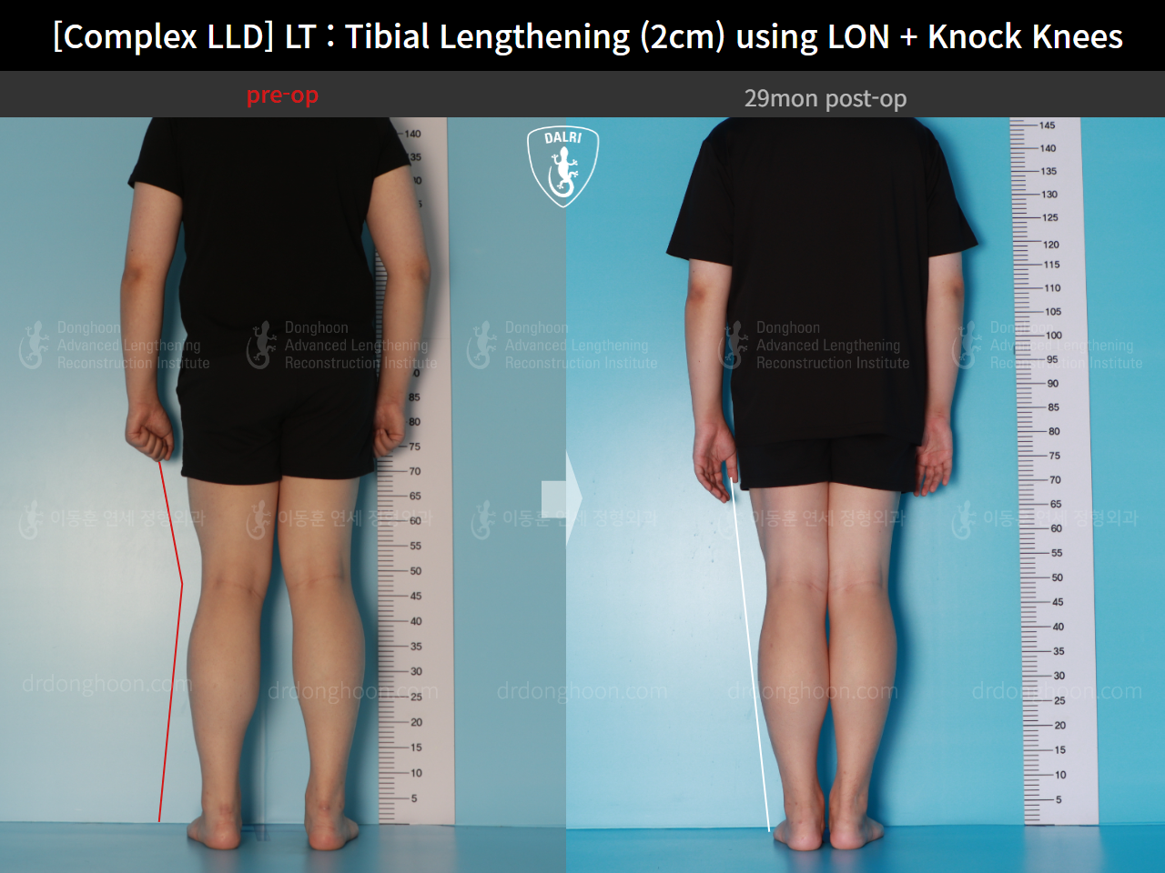 Before and after adult lld, case 16165477, image 2, Dr. Donghoon institute (DALRI)