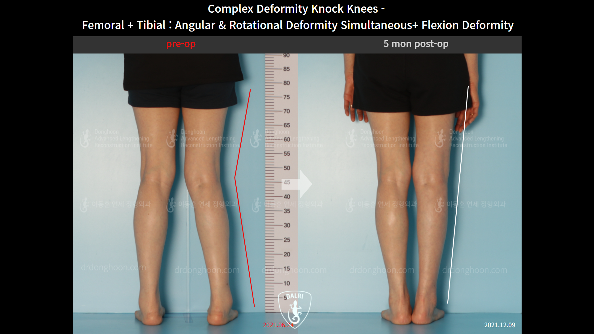 Before and after adult knock knees, case 9153798, image 5, Dr. Donghoon institute (DALRI)