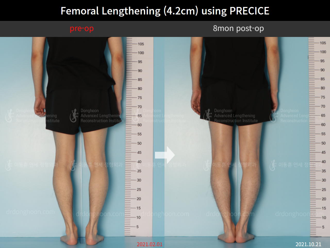 Before and after cll precice, case 8781700, image 6, Dr. Donghoon institute (DALRI)