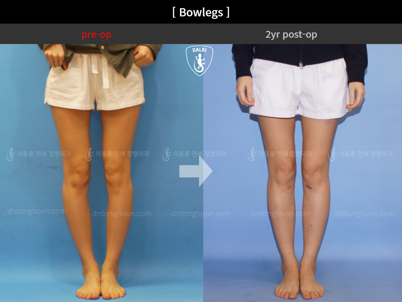 Before and after adult bowlegs, case 4311371, image 5, Dr. Donghoon institute (DALRI)