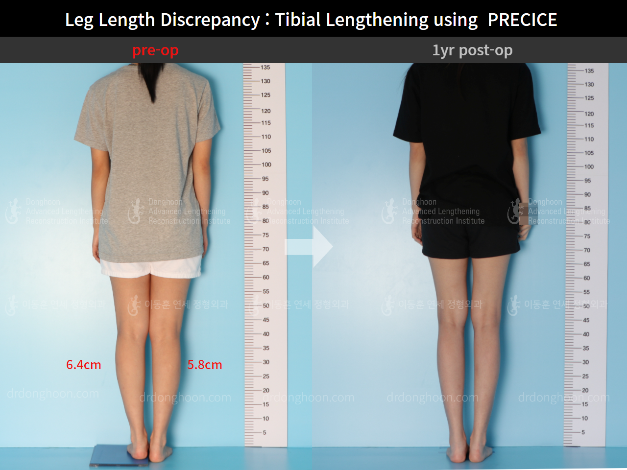 Before and after cll precice, case 4585683, image 2, Dr. Donghoon institute (DALRI)