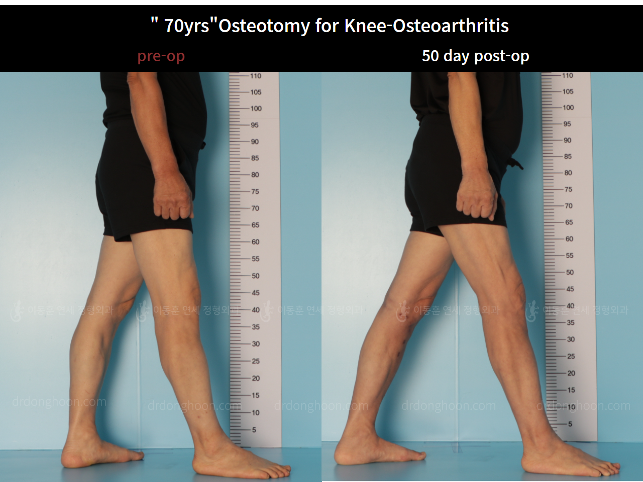 Before and after osteotomy for knee osteoarthritis, case 7753851, image 4, Dr. Donghoon institute (DALRI)
