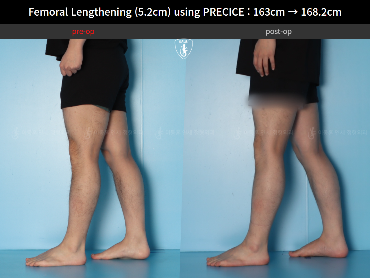 Before and after cll precice, case 55585697, image 9, Dr. Donghoon institute (DALRI)
