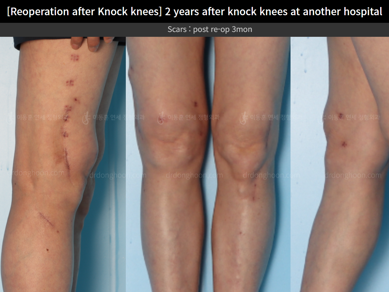 Before and after reoperation after deformity correction, case 15622876, image 11, Dr. Donghoon institute (DALRI)