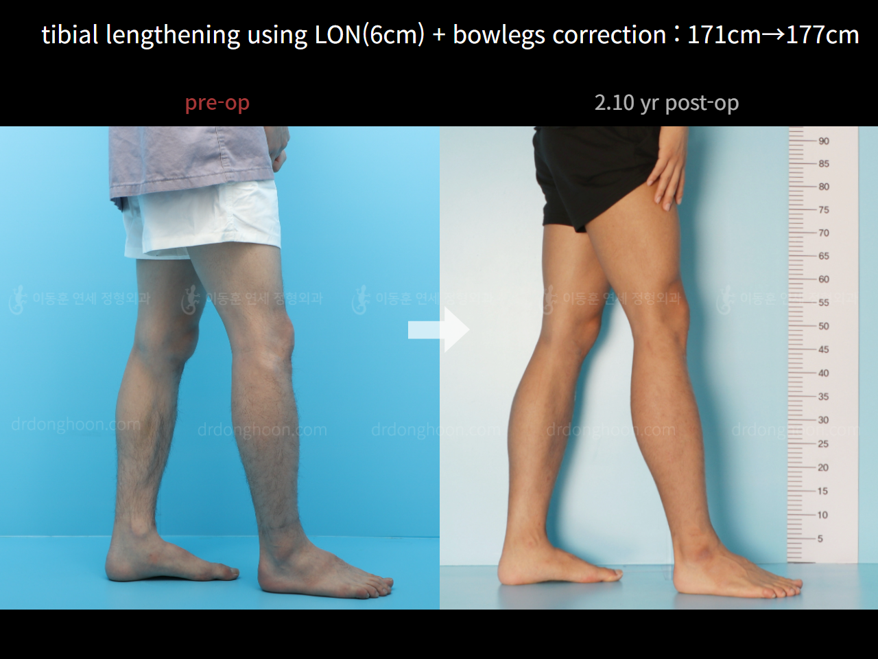 Before and after cll + deformity correction, case 7601278, image 4, Dr. Donghoon institute (DALRI)