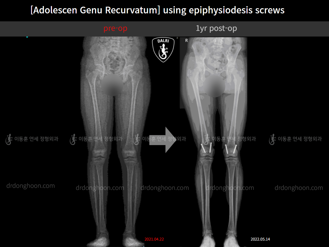 Before and after paediatric & adolescent knock knees, case 11515487, image 2, Dr. Donghoon institute (DALRI)