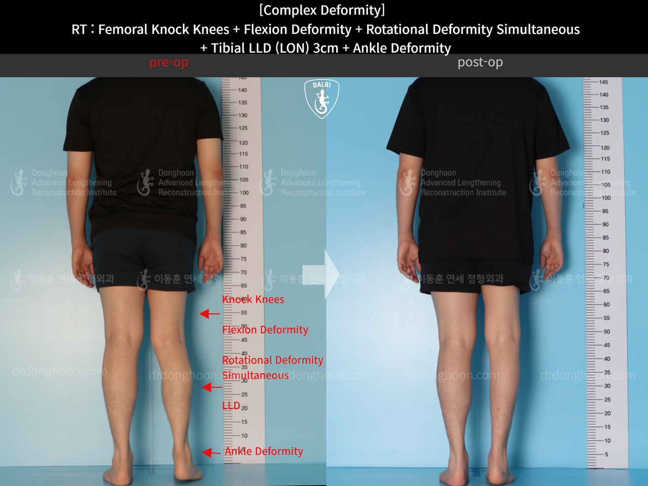 Before and after complex deformity, case 14286599, image 2, Dr. Donghoon institute (DALRI)