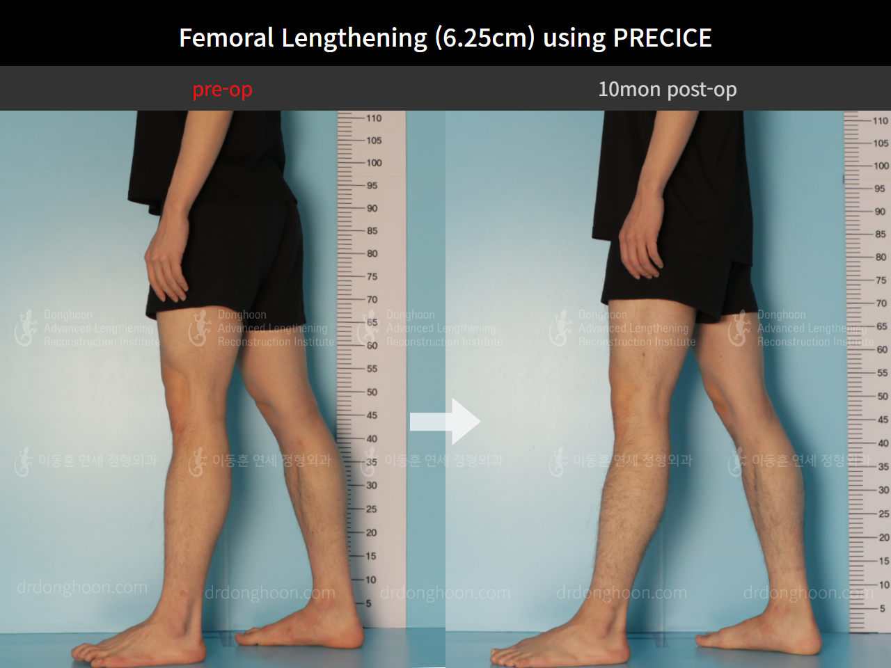 Before and after cll precice, case 8759307, image 8, Dr. Donghoon institute (DALRI)