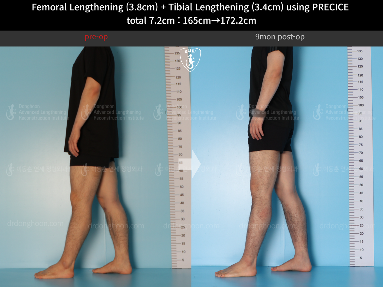Before and after cll precice, case 14220657, image 5, Dr. Donghoon institute (DALRI)