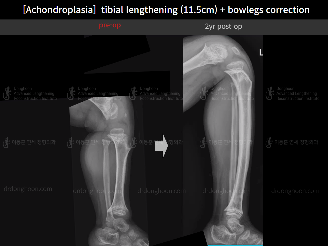 Before and after paediatric congenital condition, case 14957539, image 7, Dr. Donghoon institute (DALRI)
