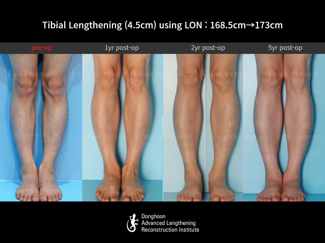 Before and after cll lon, case 16140967, image 12, Dr. Donghoon institute (DALRI)