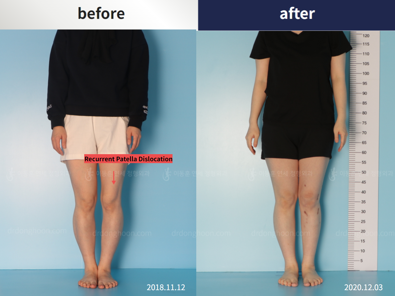 Before and after recurrent patella dislocation, case 5456889, image 1, Dr. Donghoon institute (DALRI)