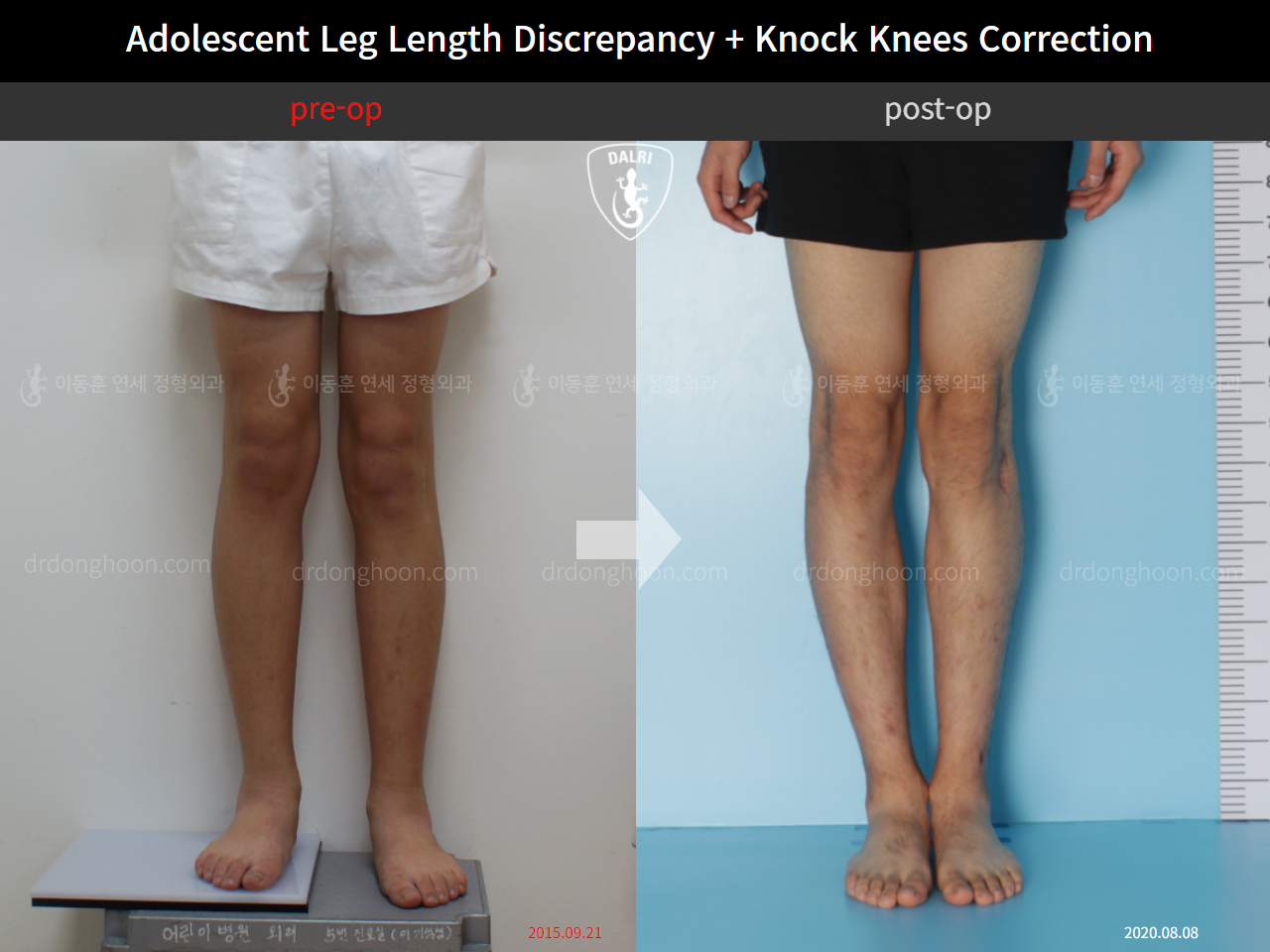 Before and after paediatric & adolescent lld, case 4585692, image 3, Dr. Donghoon institute (DALRI)