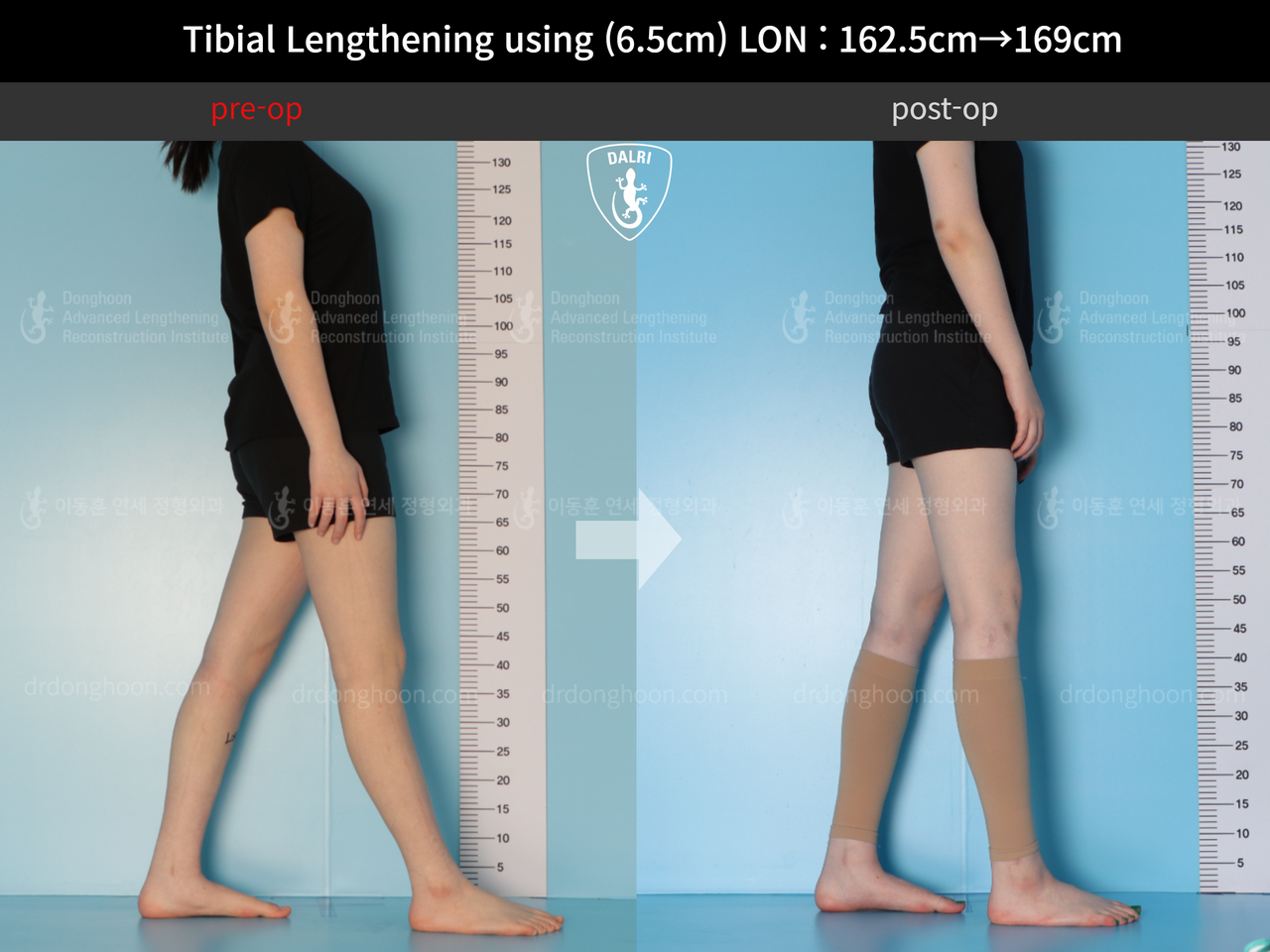 Before and after cll lon, case 12658288, image 3, Dr. Donghoon institute (DALRI)