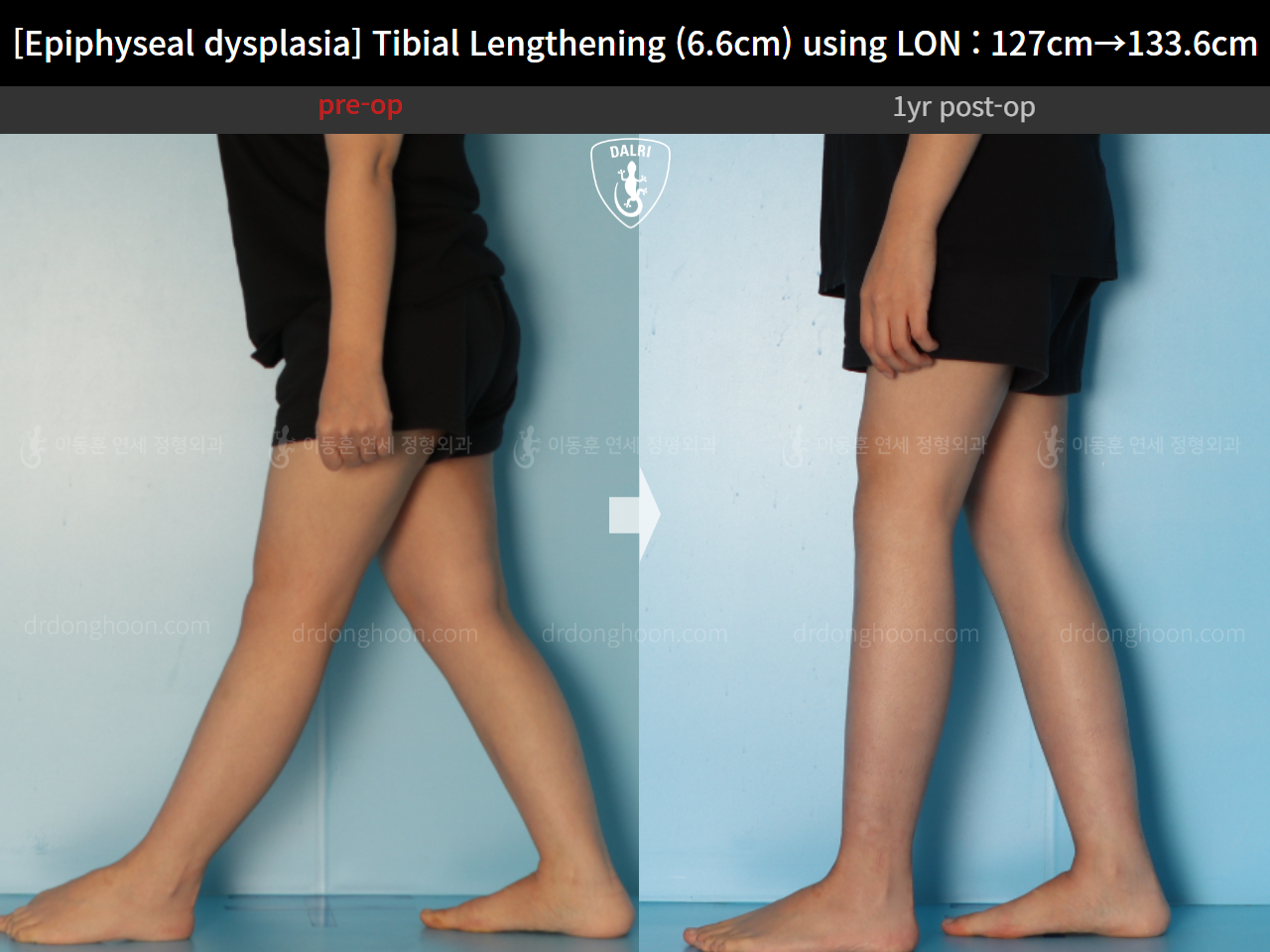 Before and after congenital condition, case 15072062, image 12, Dr. Donghoon institute (DALRI)