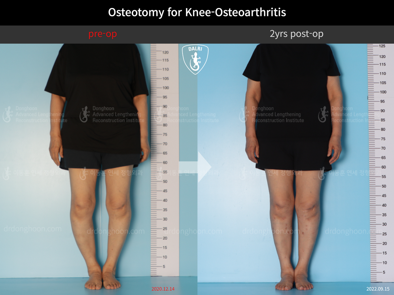 Before and after osteotomy for knee osteoarthritis, case 12844528, image 1, Dr. Donghoon institute (DALRI)