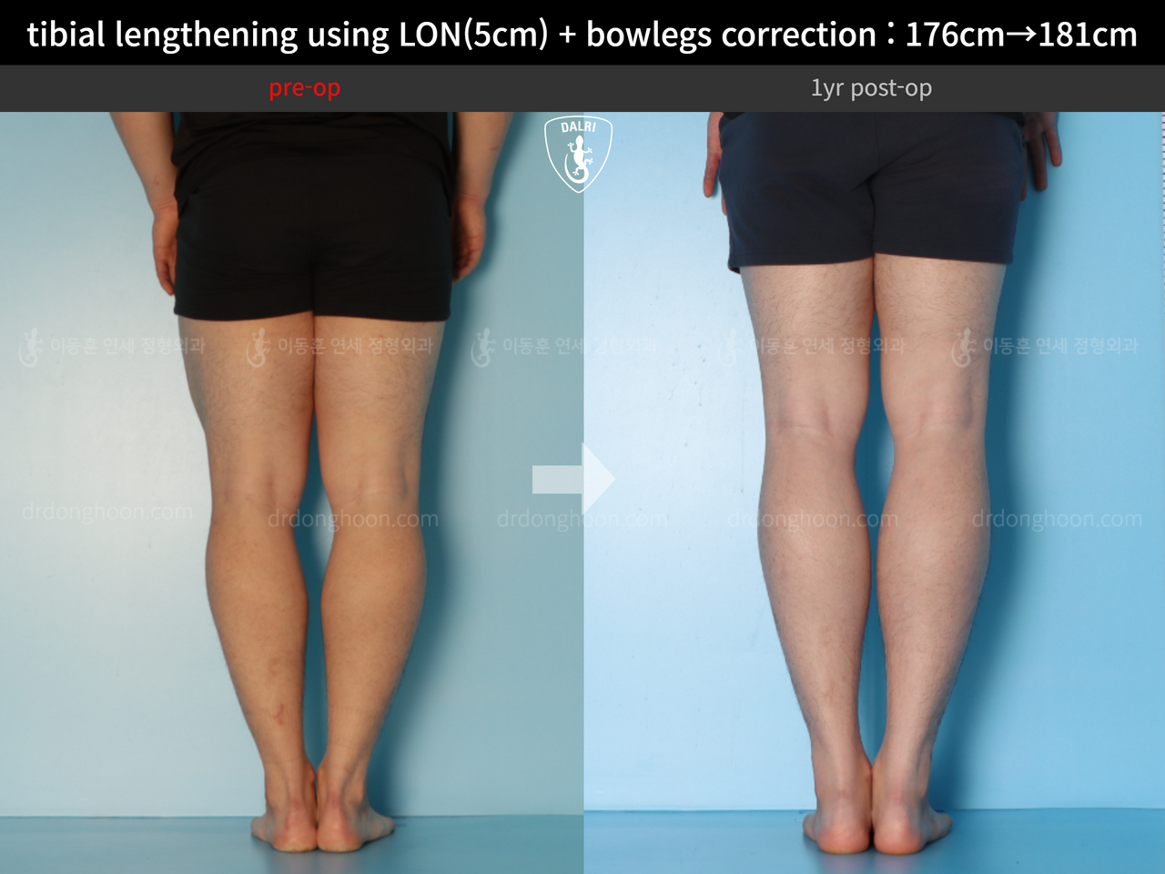 Before and after cll + deformity correction, case 13410849, image 8, Dr. Donghoon institute (DALRI)