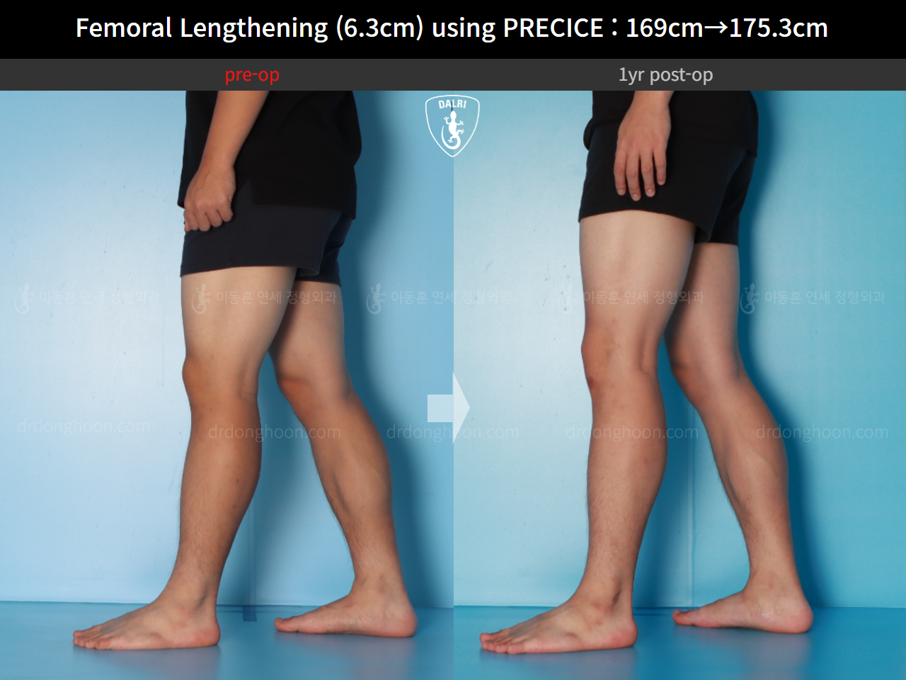 Before and after cll precice, case 16070058, image 11, Dr. Donghoon institute (DALRI)