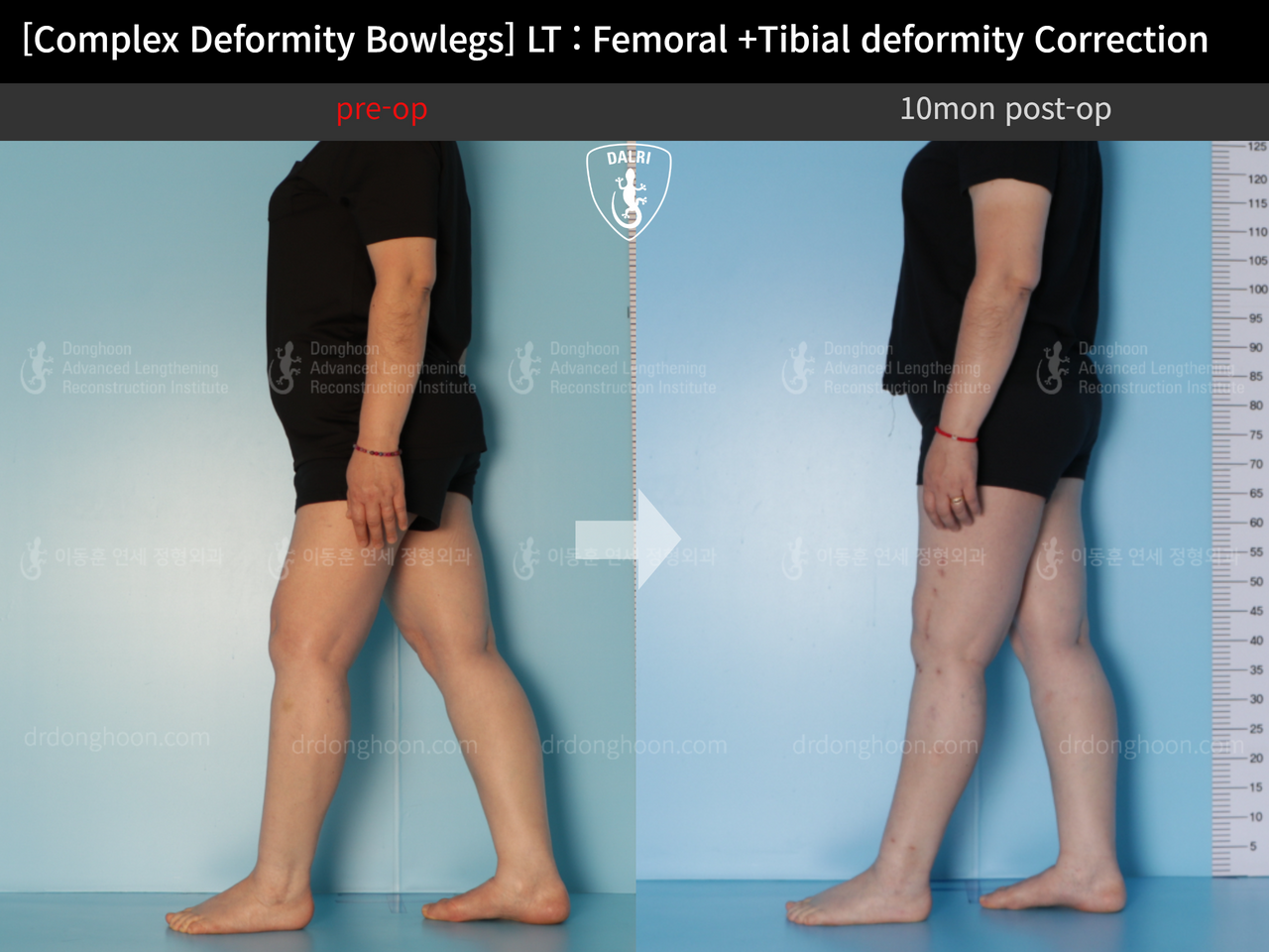 Before and after adult bowlegs, case 12790433, image 3, Dr. Donghoon institute (DALRI)