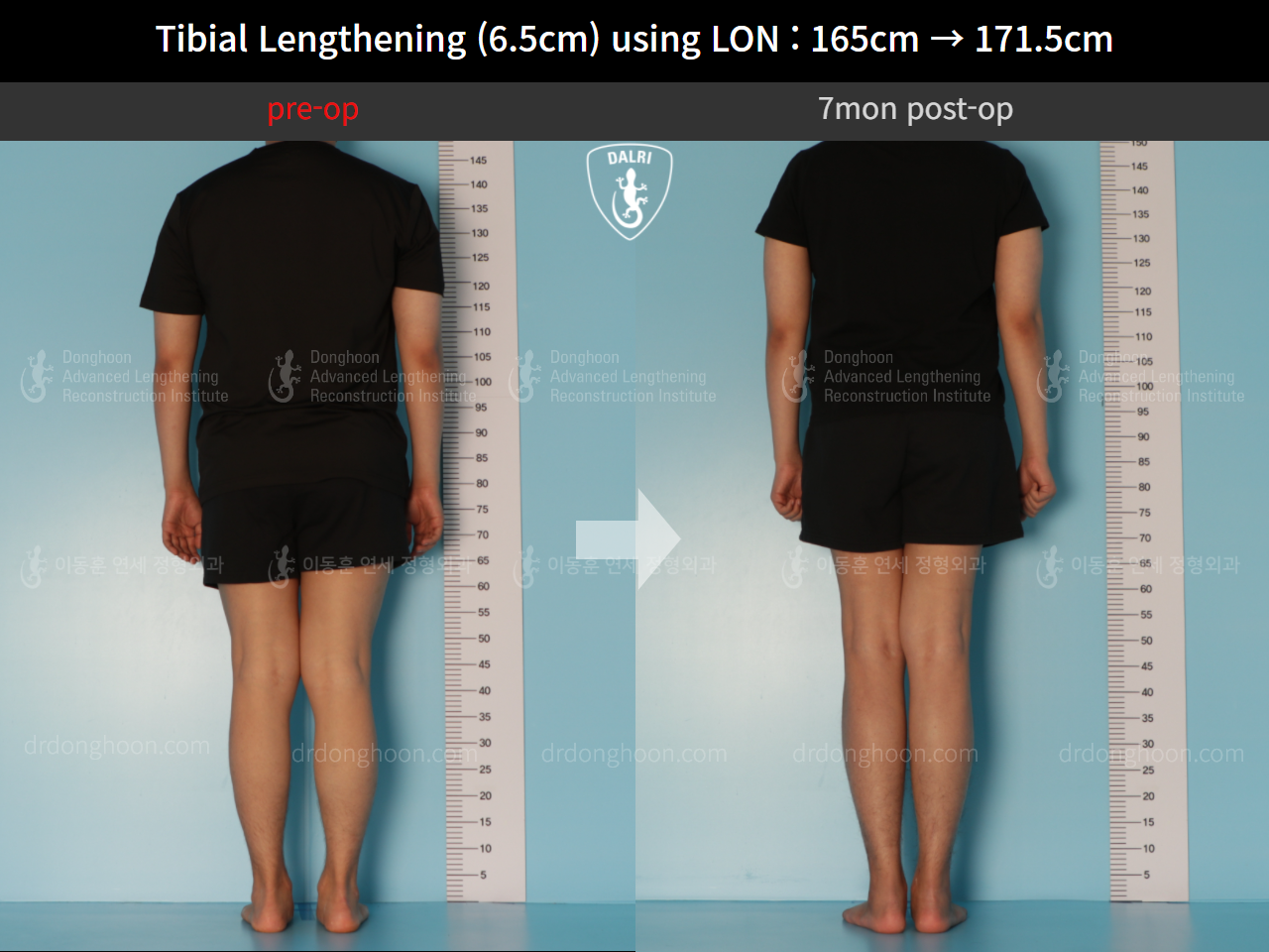 Before and after cll lon, case 10388000, image 2, Dr. Donghoon institute (DALRI)