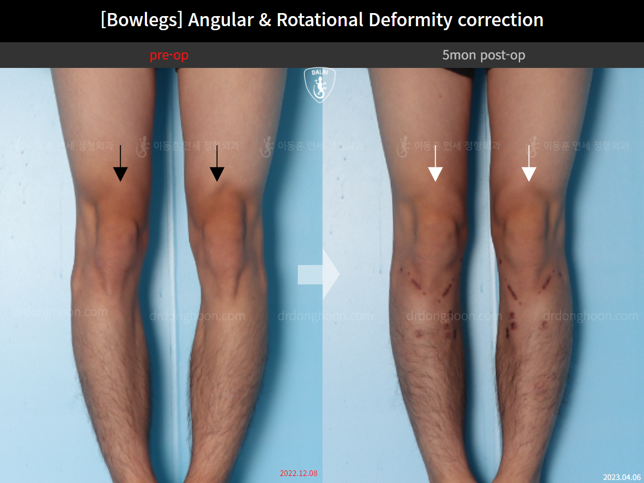 Before and after adult bowlegs, case 14707617, image 5, Dr. Donghoon institute (DALRI)
