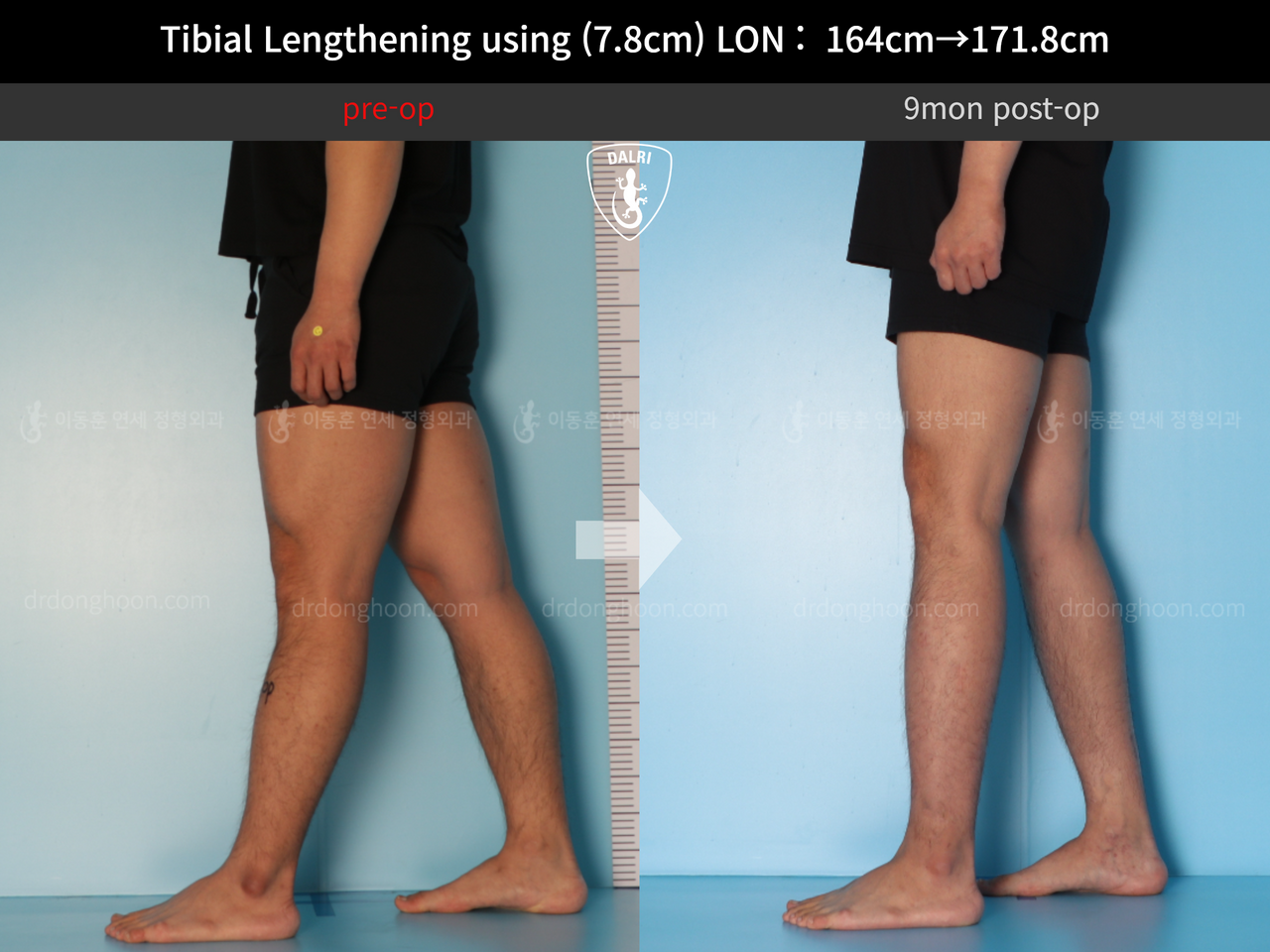Before and after cll lon, case 12652002, image 8, Dr. Donghoon institute (DALRI)