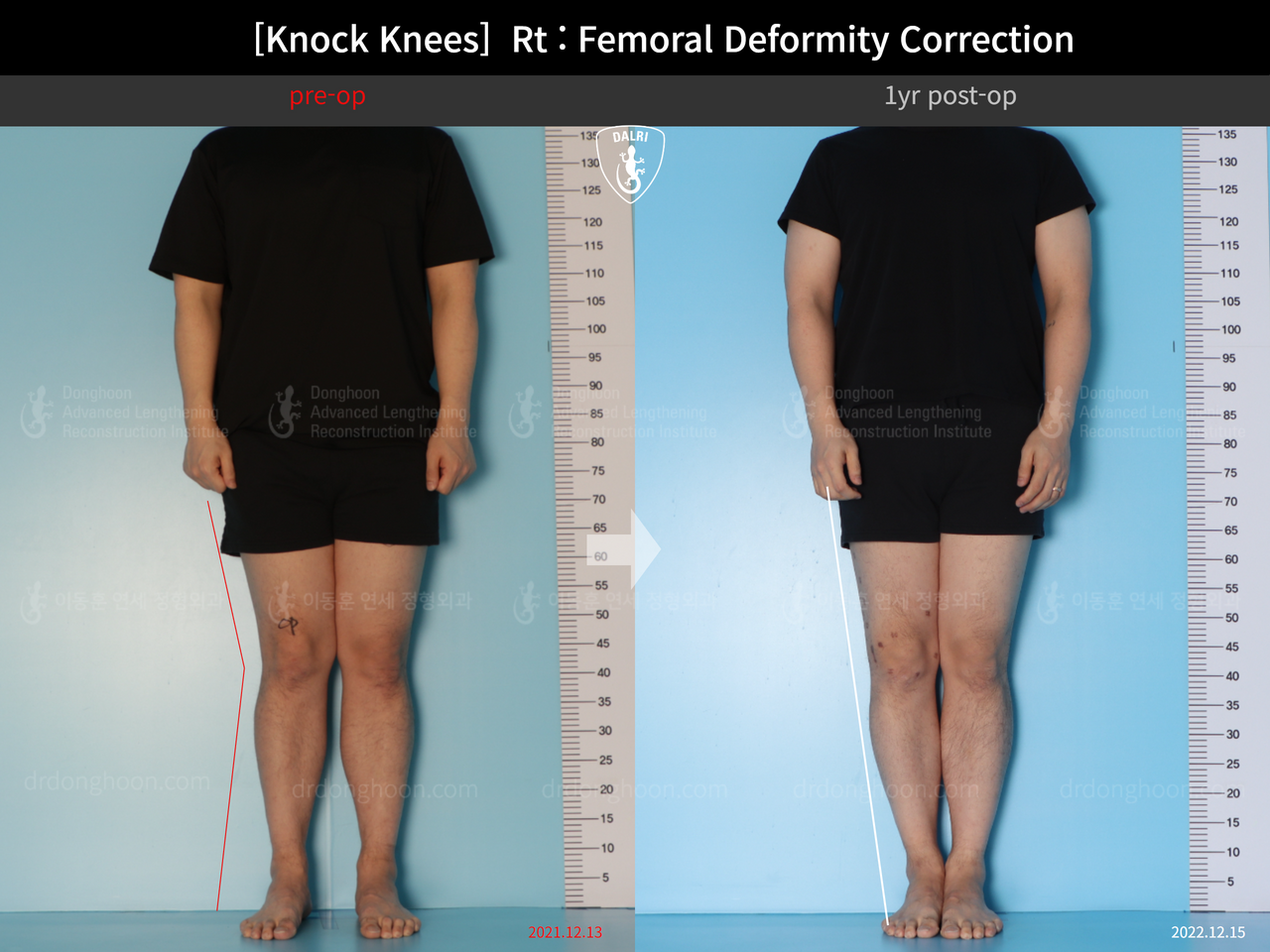 Before and after adult knock knees, case 14009233, image 1, Dr. Donghoon institute (DALRI)