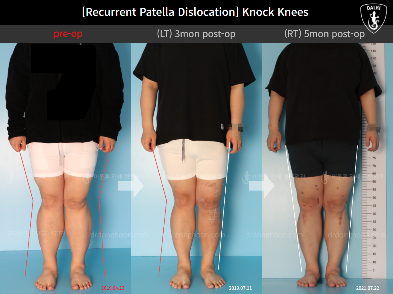 Before and after adult knock knees, case 10710317, image 1, Dr. Donghoon institute (DALRI)