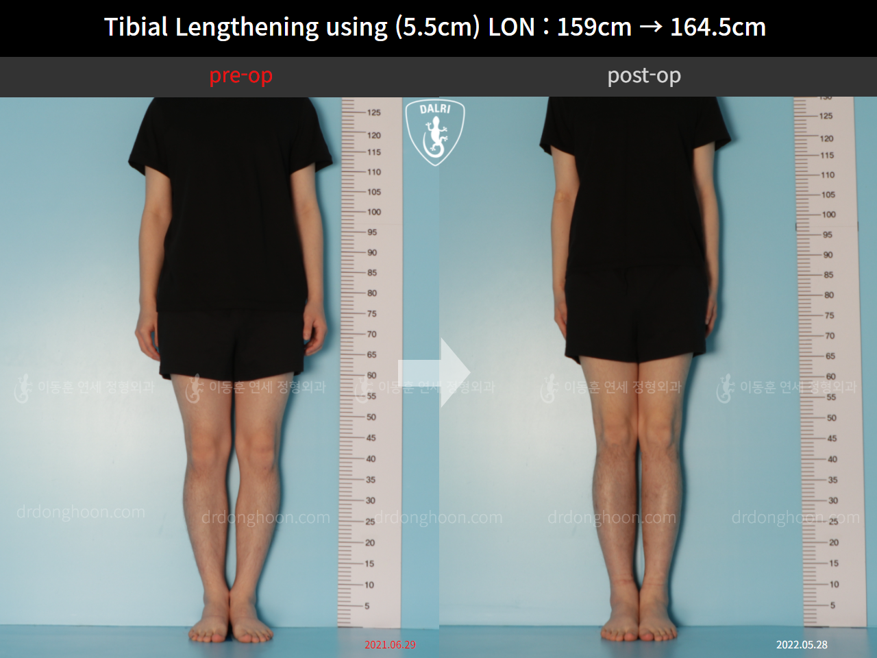 Before and after cll lon, case 11747999, image 1, Dr. Donghoon institute (DALRI)