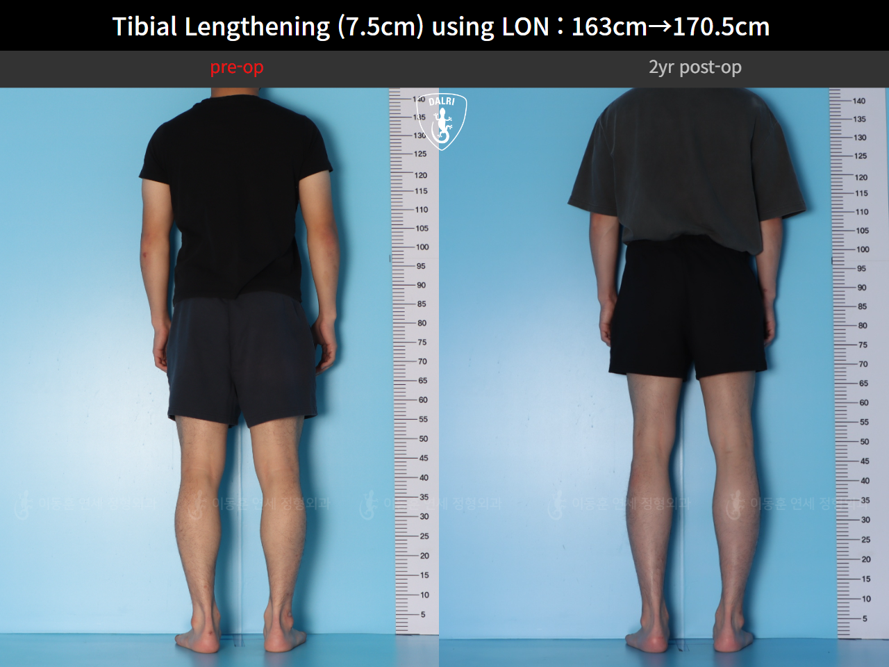 Before and after cll lon, case 125785462, image 4, Dr. Donghoon institute (DALRI)