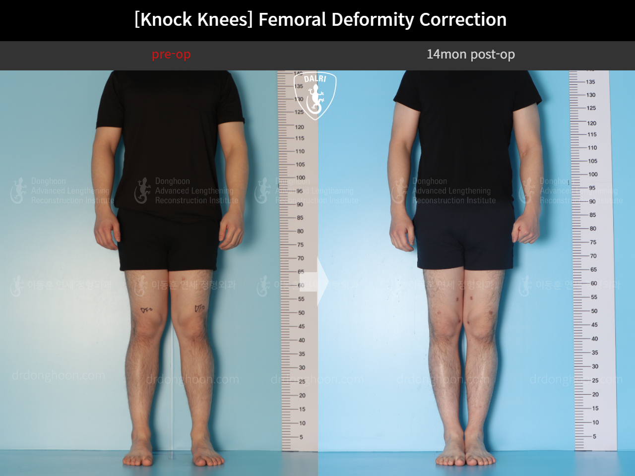 Before and after adult knock knees, case 15816319, image 5, Dr. Donghoon institute (DALRI)