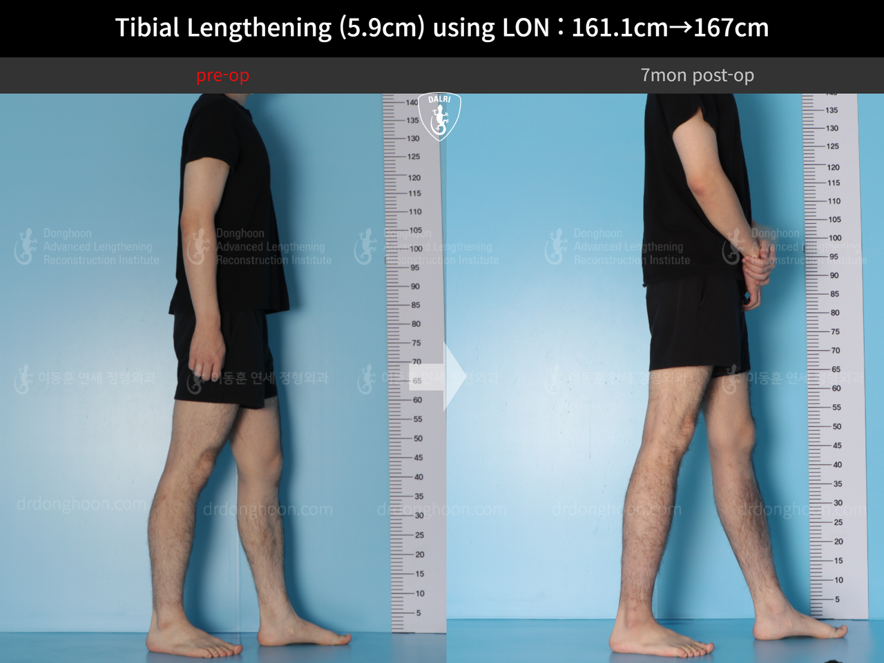 Before and after cll lon, case 14064750, image 4, Dr. Donghoon institute (DALRI)