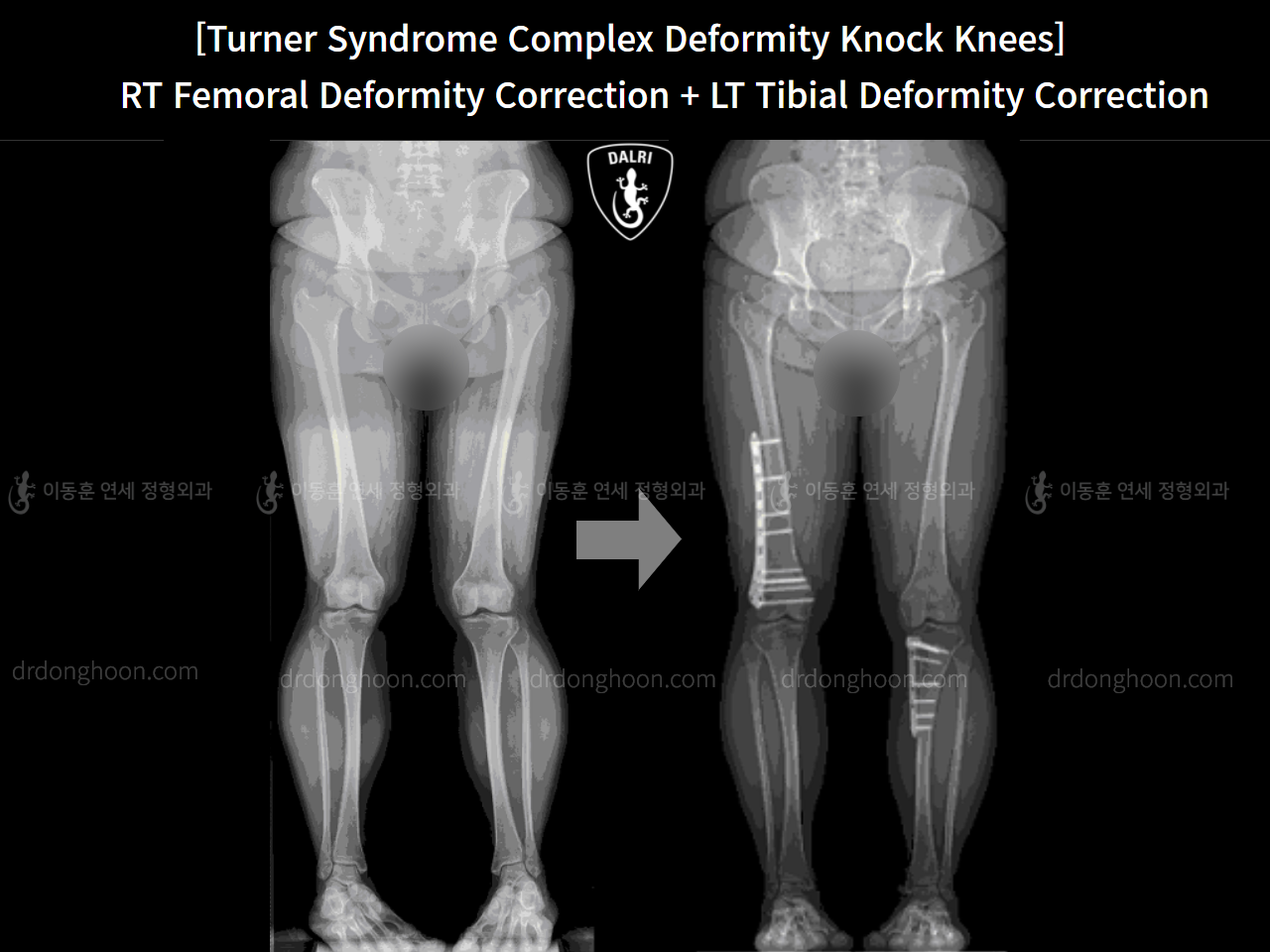 Before and after congenital condition, case 4640660, image 4, Dr. Donghoon institute (DALRI)