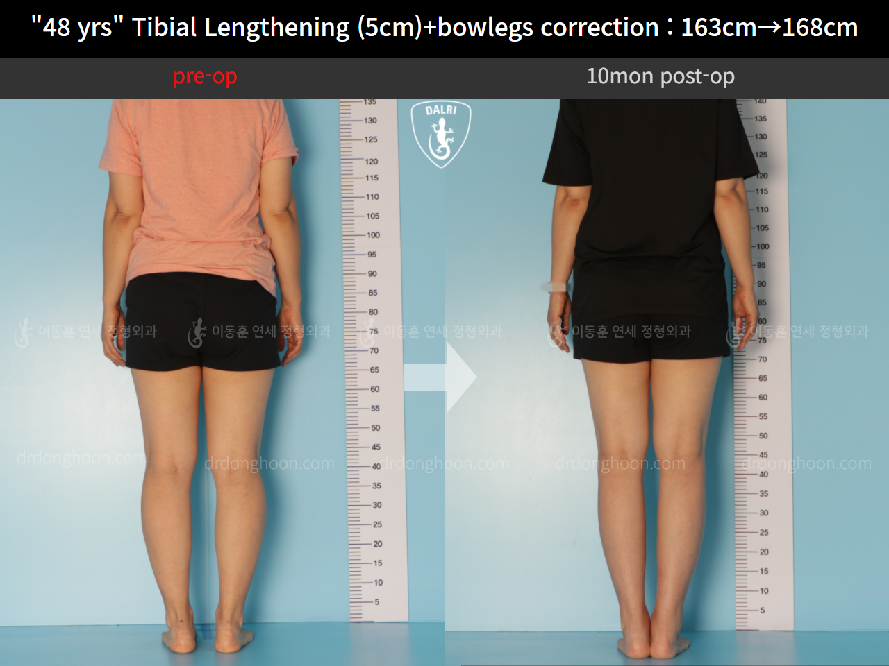 Before and after cll + deformity correction, case 10452764, image 2, Dr. Donghoon institute (DALRI)