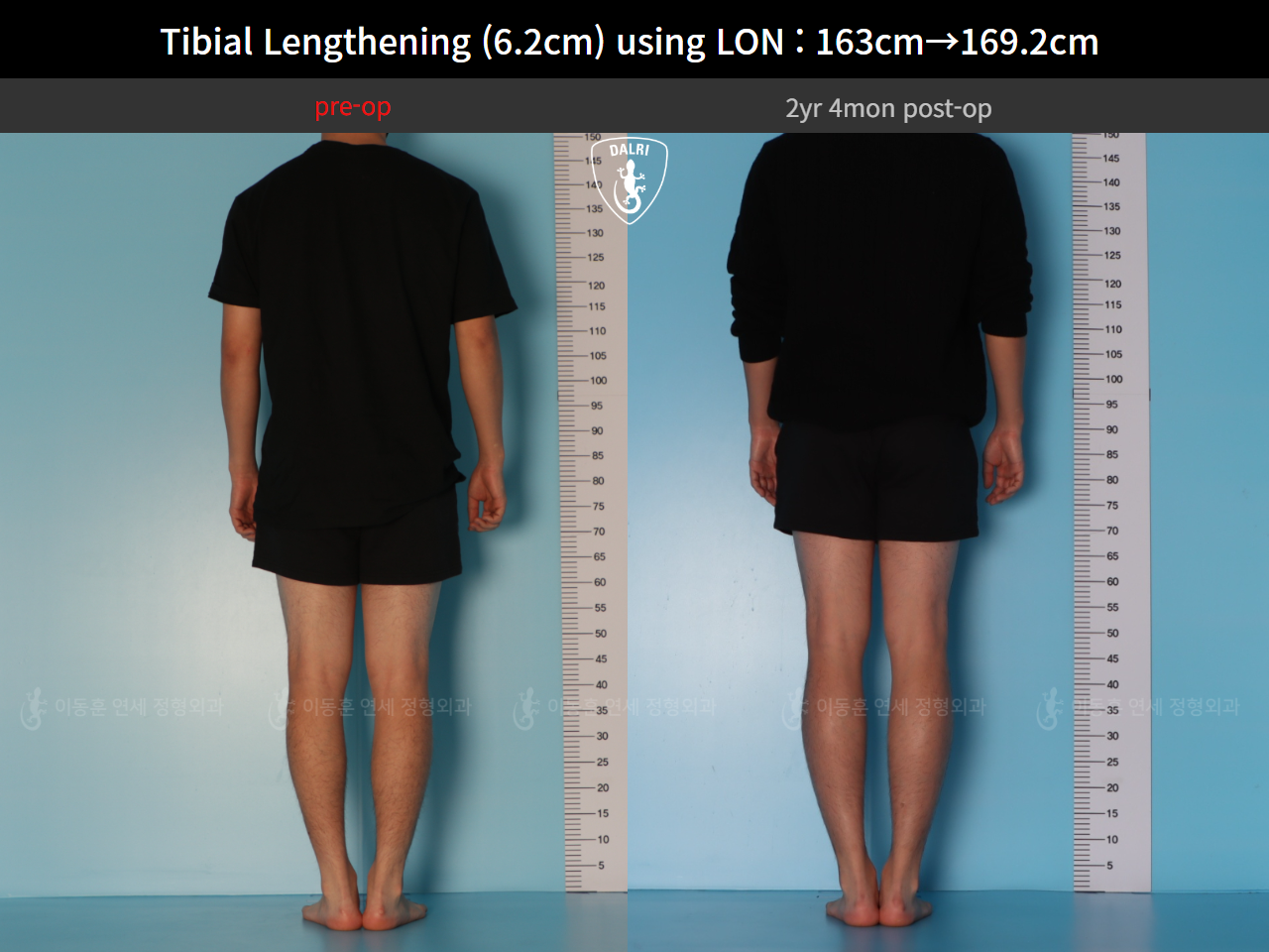 Before and after cll lon, case 128449546, image 2, Dr. Donghoon institute (DALRI)