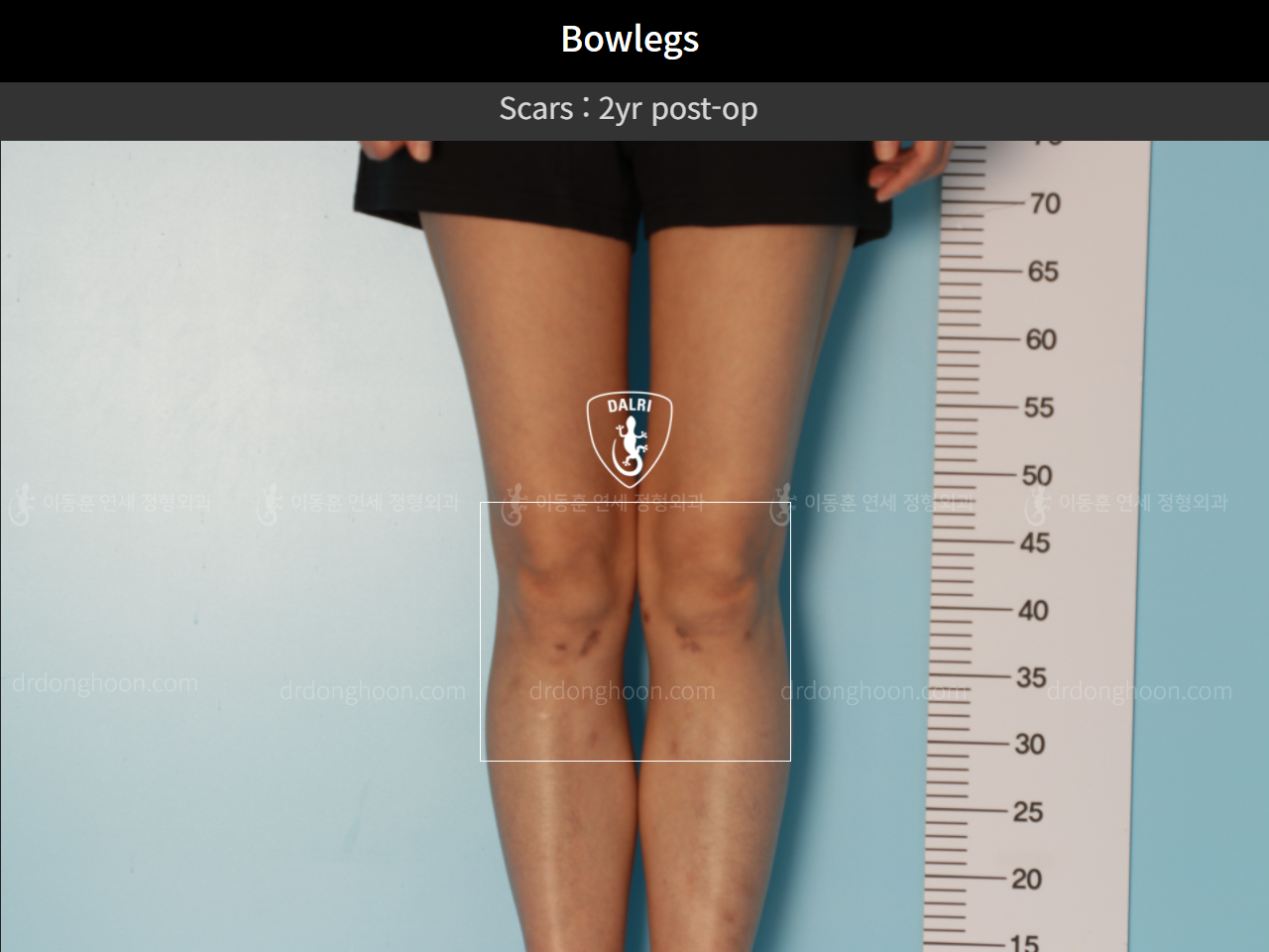 Before and after adult bowlegs, case 10023318, image 9, Dr. Donghoon institute (DALRI)