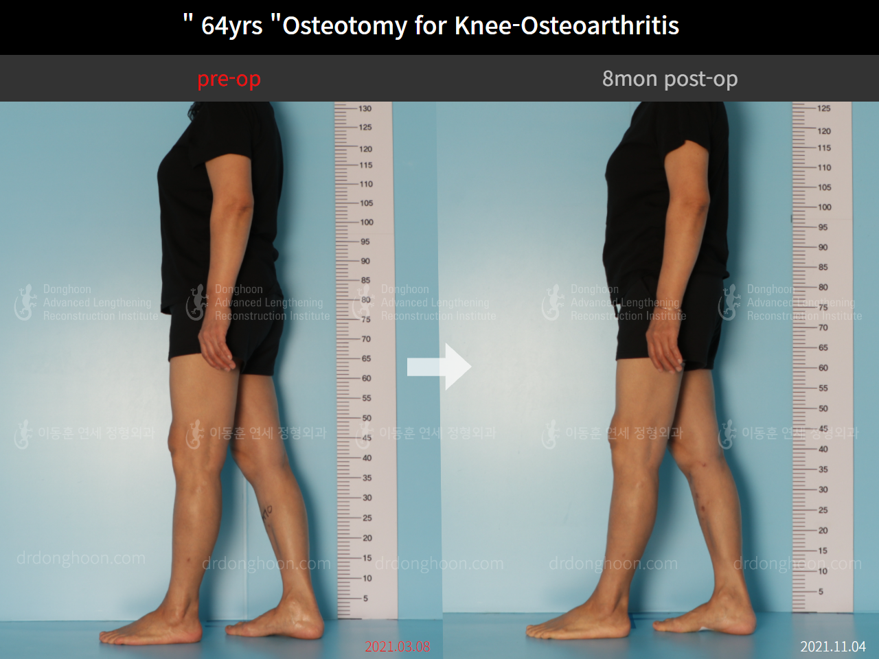 Before and after osteotomy for knee osteoarthritis, case 8761106, image 4, Dr. Donghoon institute (DALRI)