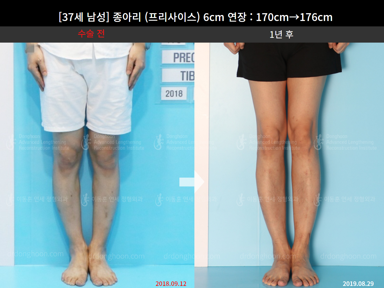 Before and after cll precice, case 4573549, image 4, Dr. Donghoon institute (DALRI)