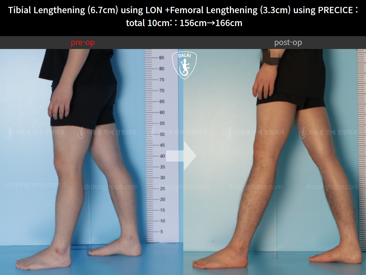 Before and after cll lon, case 11044268, image 8, Dr. Donghoon institute (DALRI)